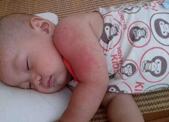 黄皮叶煮水能去黄疸吗,可以/还能去除痱子消毒杀菌